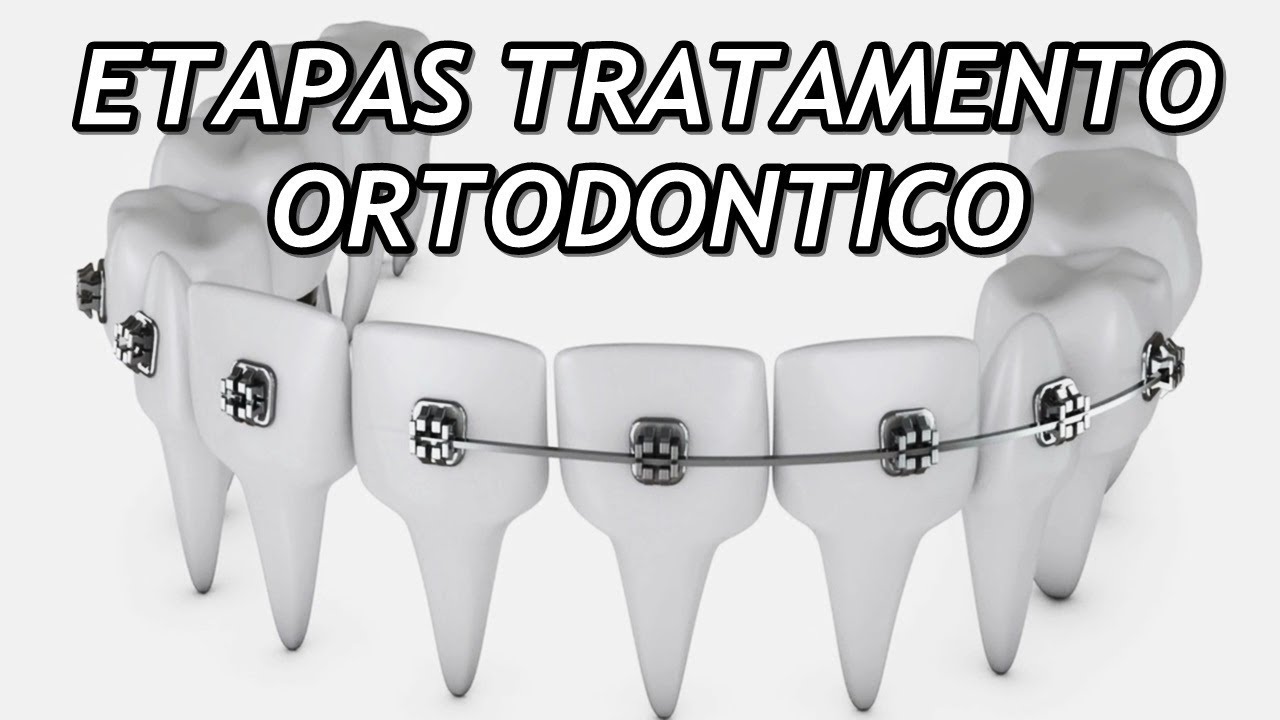 Quais as etapas de um tratamento ortodôntico?