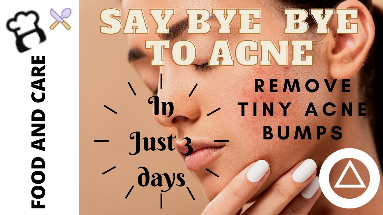 Remove Acne in 7 days at Home | Get Rid of Acne Bumps in a Week | Food and Care