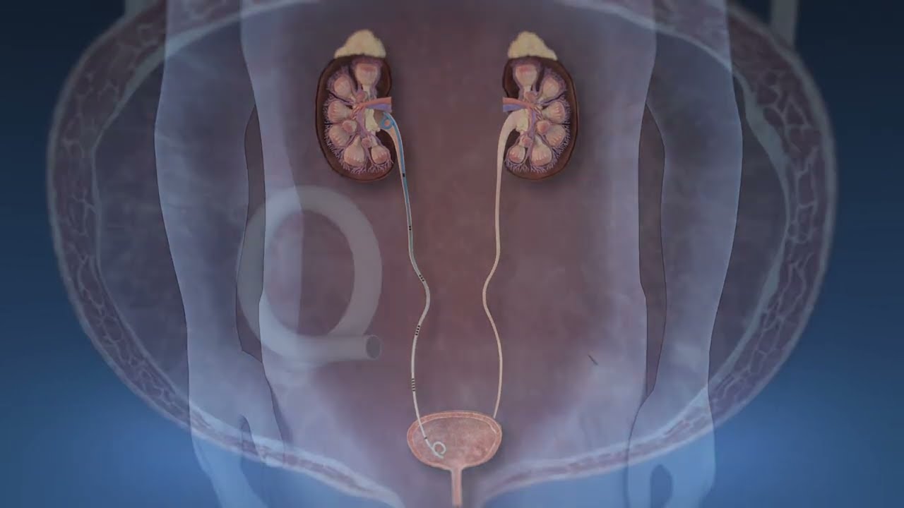 Kidney Stone PCNL Stent