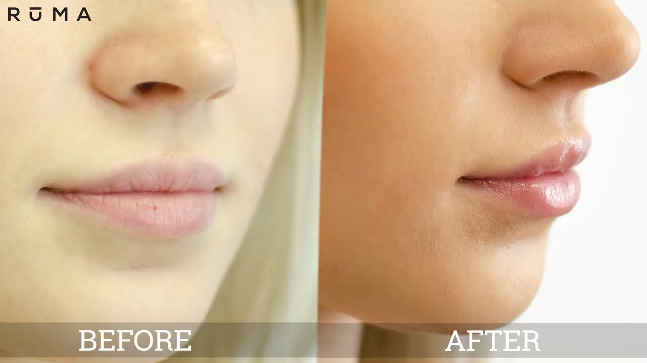 Natural Lip Filler Before & After by Emily