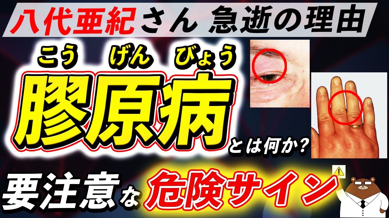 放置厳禁！知らないと後悔する「膠原病」が引き起こす体の変化。なぜ八代亜紀さんは急逝したのか。初期の危険サインとは？医師が徹底解説！