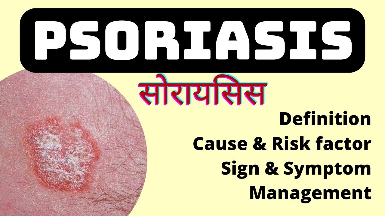 psoriasis skin disease in hindi | Cause, risk factor, symptoms and treatment | MSN | soriasis