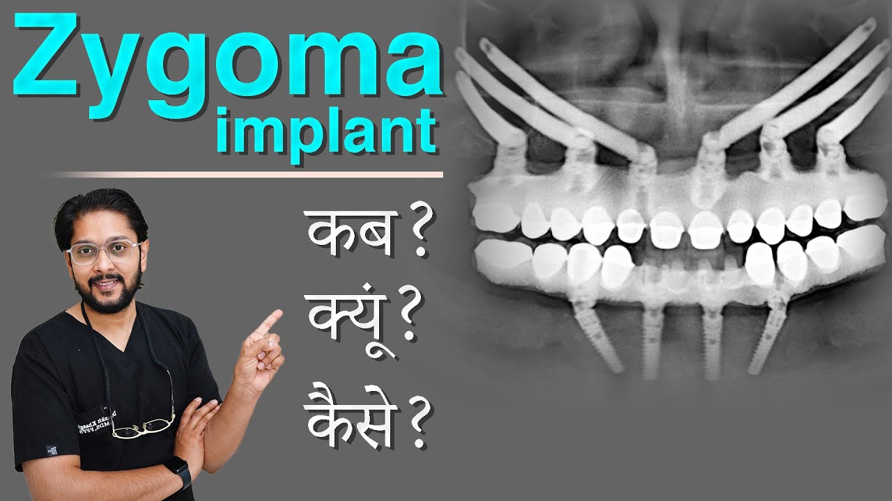 Zygomatic Implants in India | Full Guide | Best Dental Implant Solution in Indore for Bone Loss