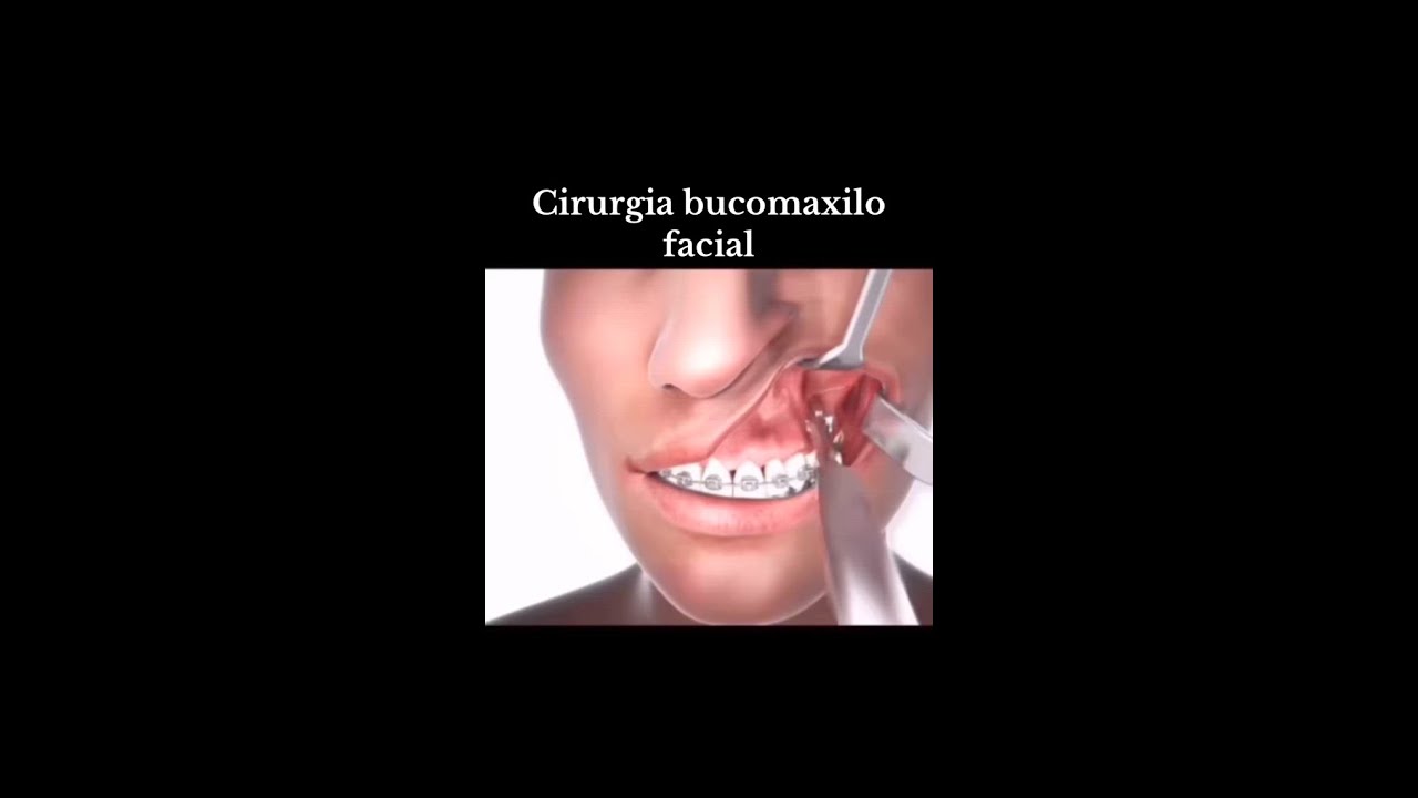 Cirurgia bucomaxilofacial