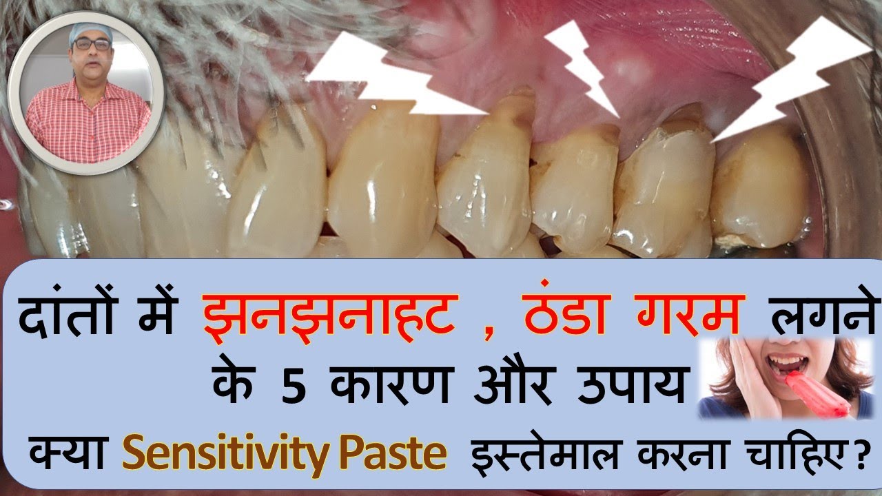 दांतों में झनझनाहट, ठंडा गरम लगने के 5 कारण और उपाय, क्या Sensitivity paste इस्तेमाल करना चाहिए.