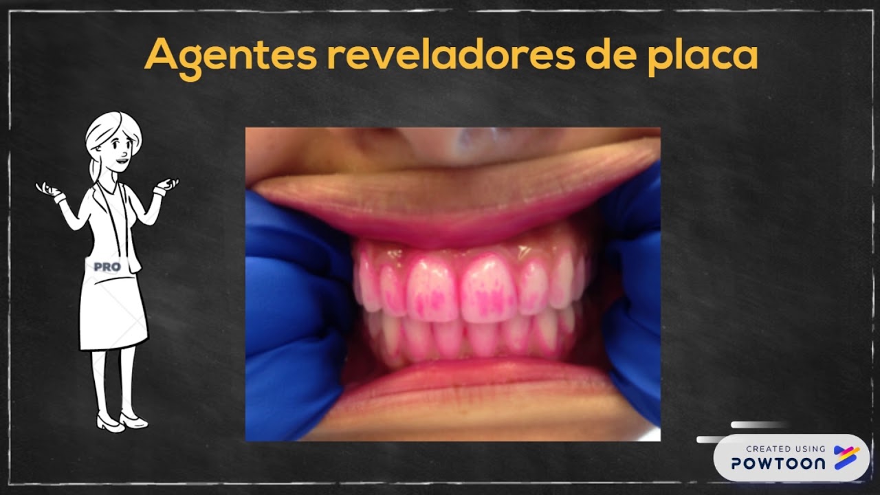 Biopelícula Unidad II Formación, patogenia y control de la biopelícula oral