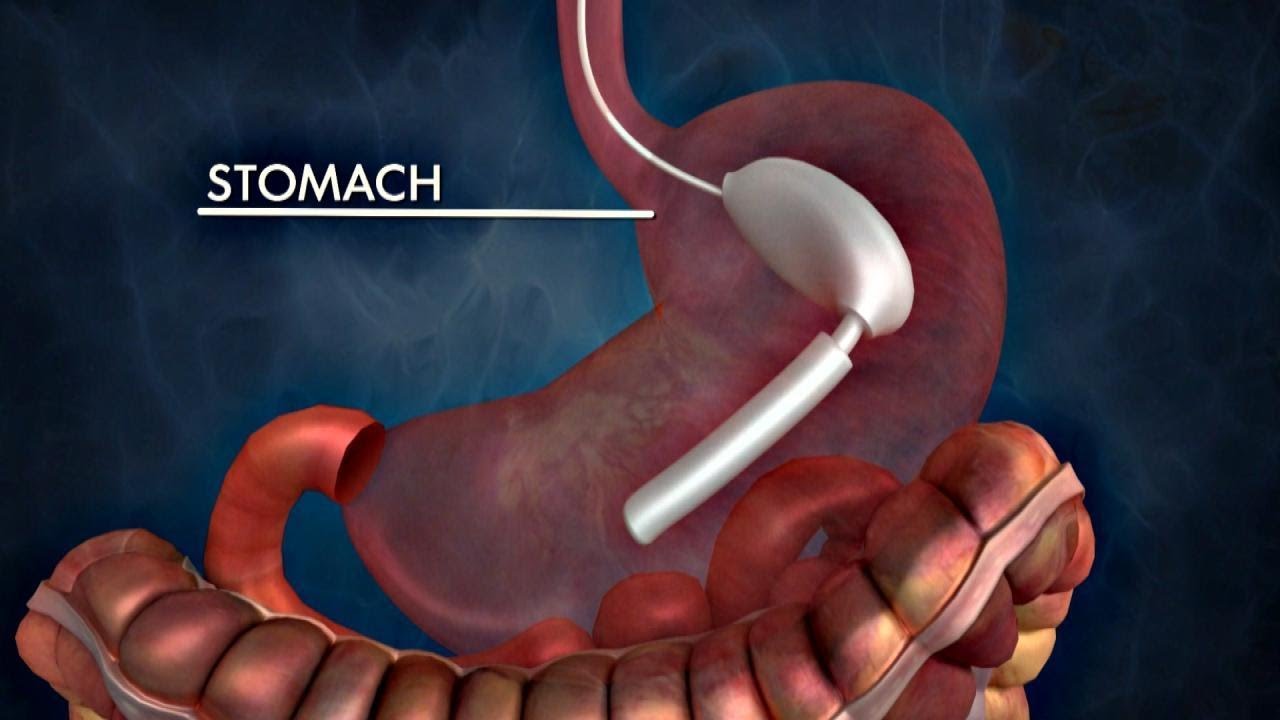 The Possible Dangers of Gastric Balloons for Weight Loss