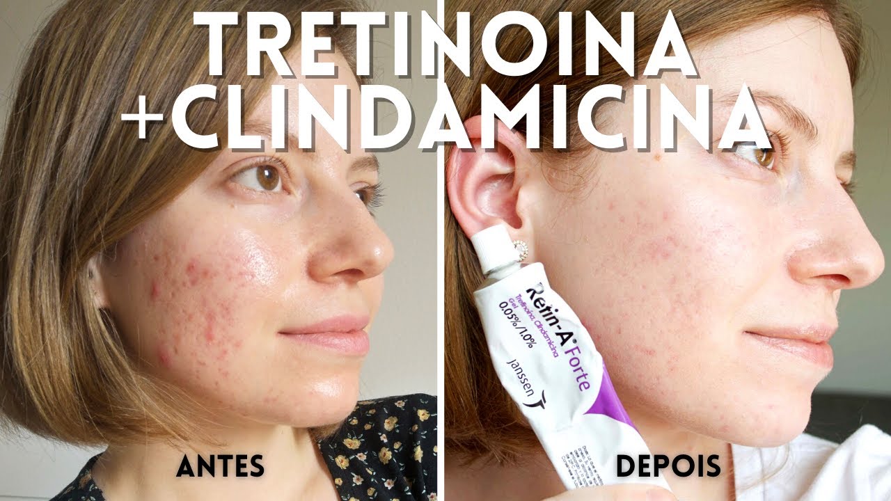 VITACID ACNE: Tretinoina e Clindamicina para Tratar a Acne | Produtos para Acne QUE FUNCIONAM! EP 02