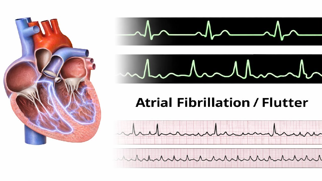Atrial Fibrillation:Flutter