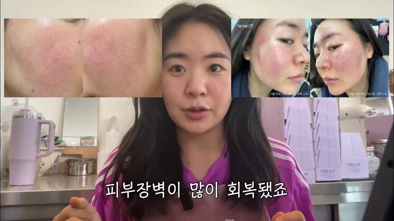 😡홍조탈출 꿀팁 싹 다 풉니다🥹🍀