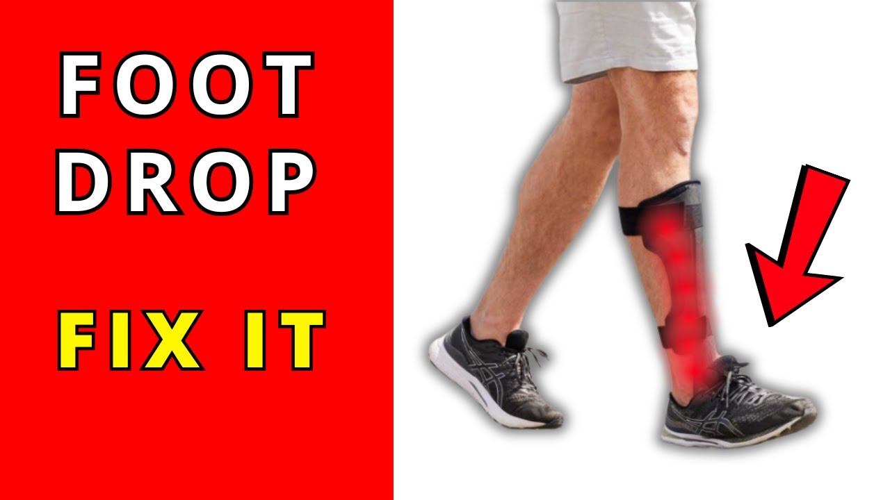 Can foot drop be cured without surgery