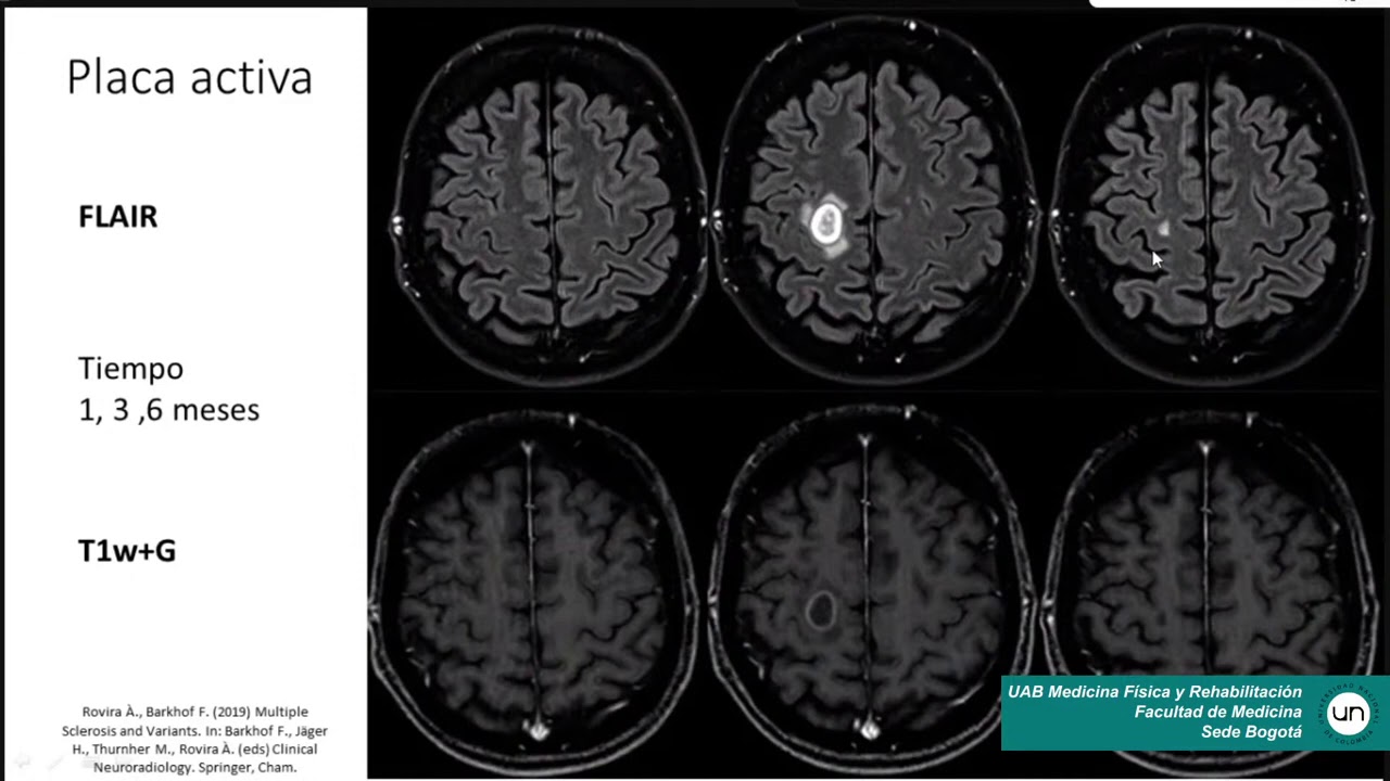 Rehabilitación esclerosis múltiple I