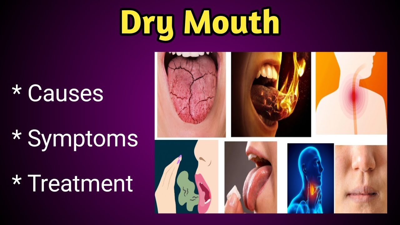 Dry Mouth Causes, Symptoms and Treatment| Xerostomia.