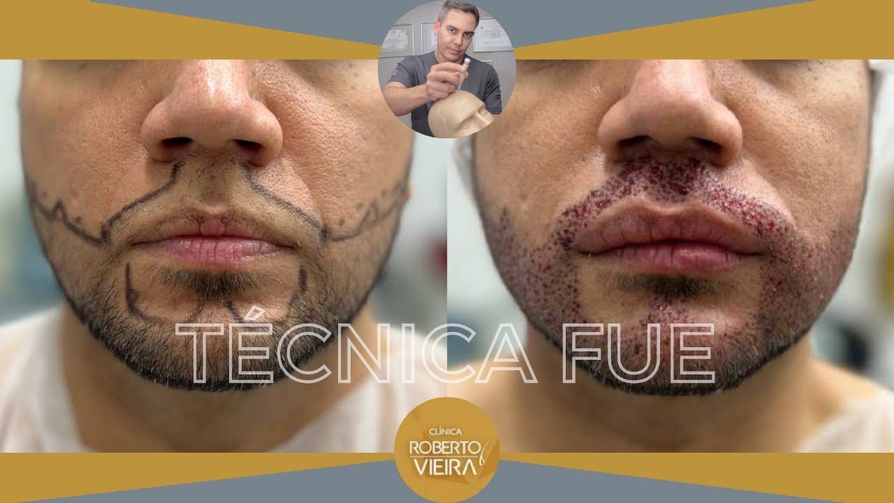 3 casos de transplante capilar em Barba🔥
