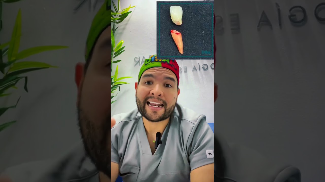 Fracturas dentales ¿Que tratamientos hay??