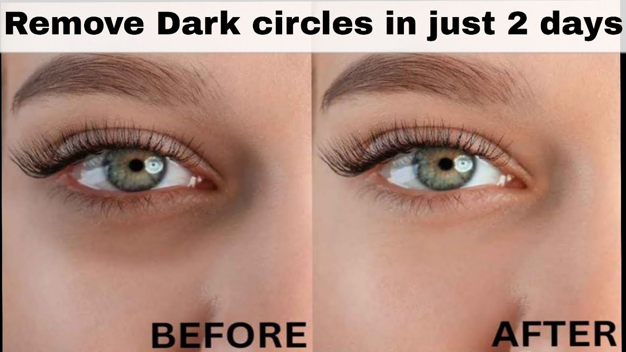How to remove dark circles naturally at home in just 2 days | Get a rid of your dark circles 