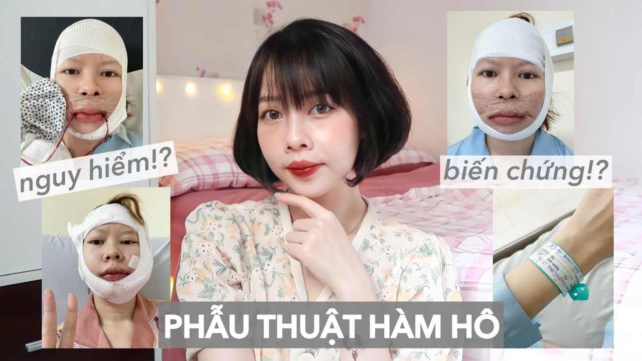 MÌNH ĐÃ TRỞ LẠI SAU PHẪU THUẬT HÀM HÔ 🥳 Ny Nguyễn