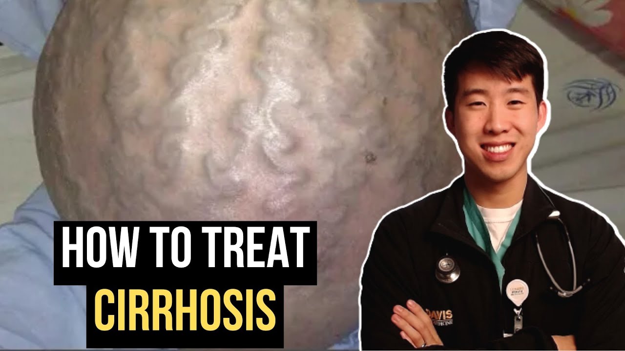 How To Treat Cirrhosis (Every Complication Explained)