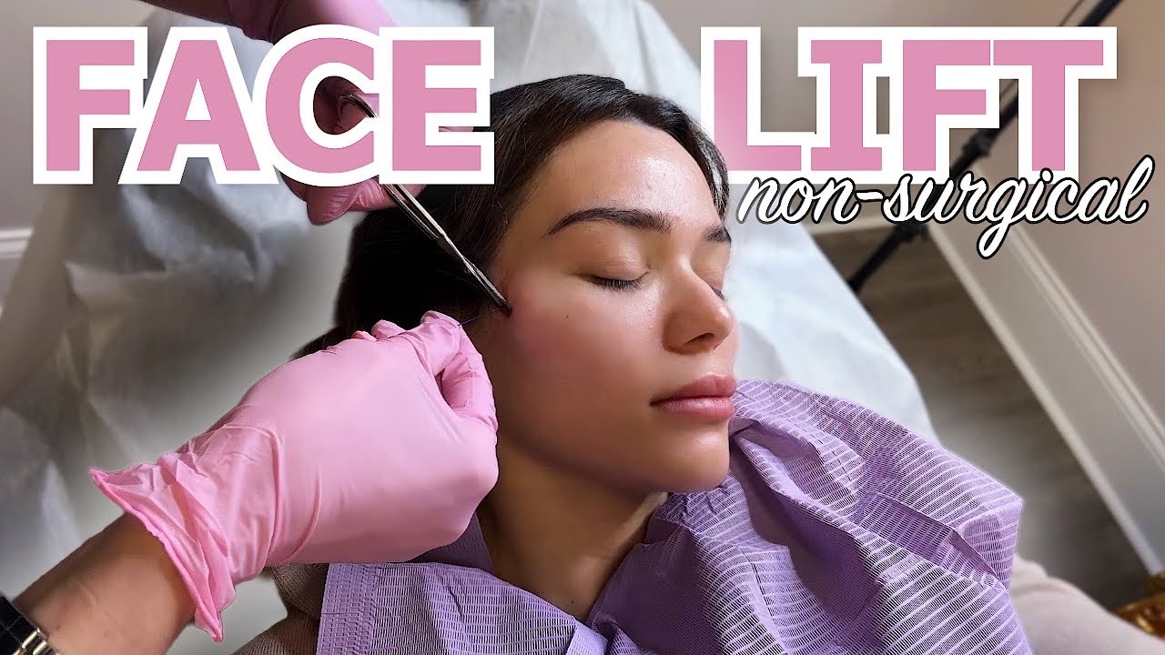 NON SURGICAL FACELIFT WITH PDO THREADS!! 