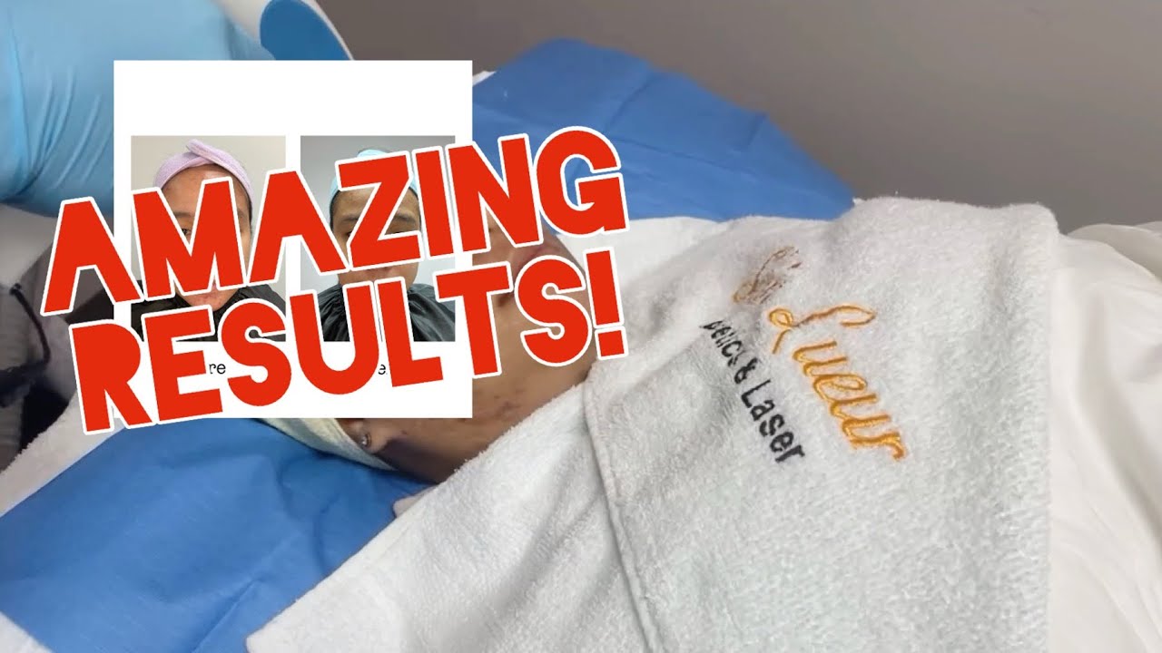 How to Get Rid of Acne Scars Completely/Acne problems/ your solution| Canada/SkinLueurPlasmaLift