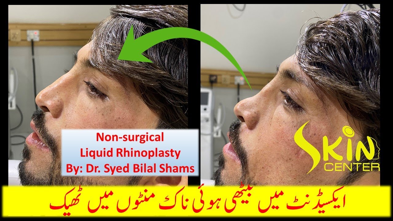 Nonsurgical liquid rhinoplasty by top skin specialist & cosmetologist Dr Syed Bilal Shams