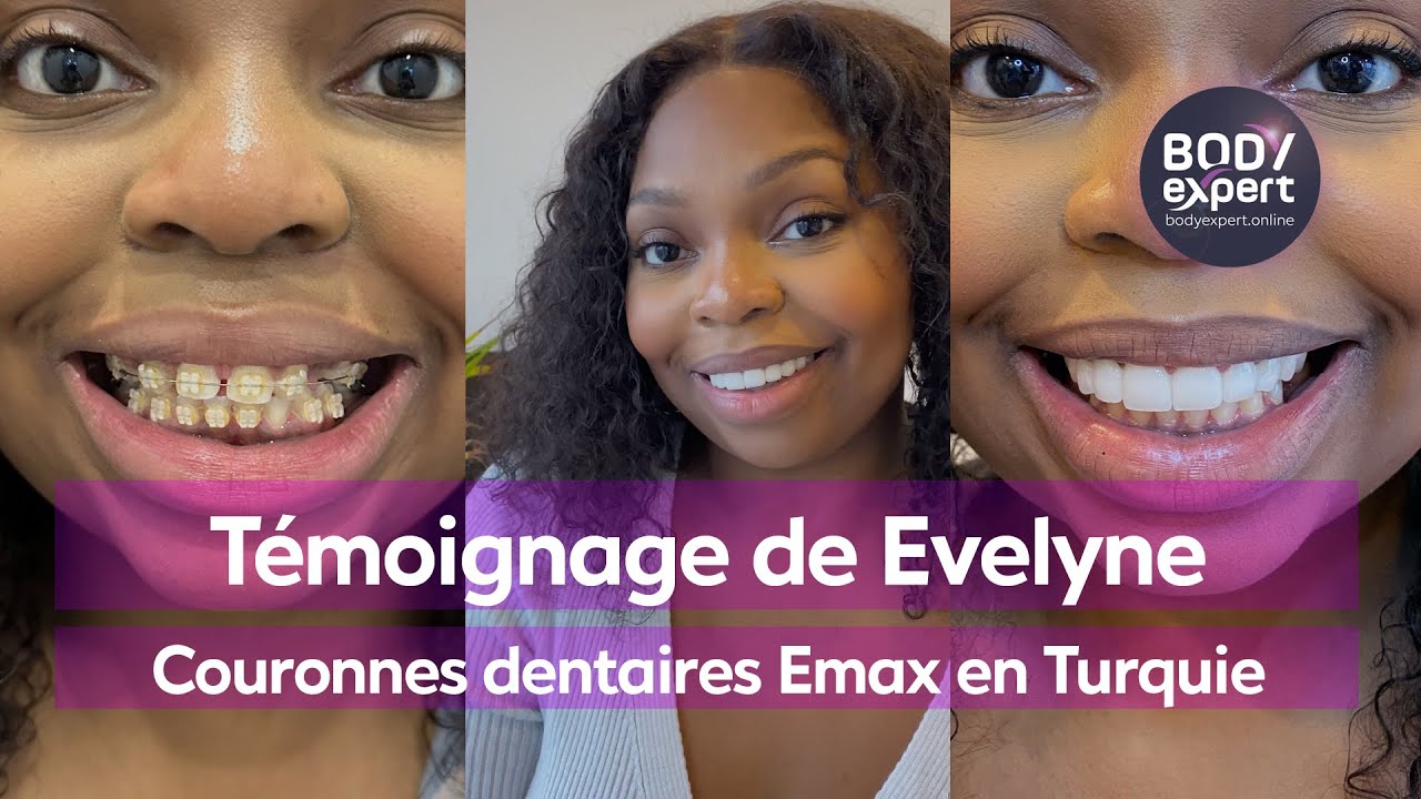 DENTISTE EN TURQUIE  | 🦷 Témoignage Evelyne : 10 couronnes Emax +  blanchiment | BODYEXPERT