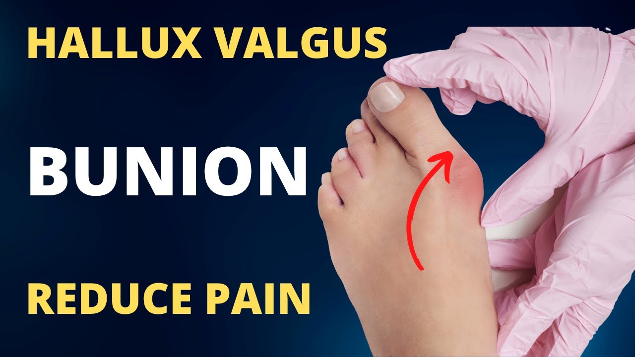 Bunions (Hallux Valgus) Treatment at Home Without Surgery