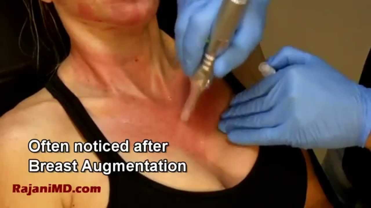 Decollete-Refresh Your Neck-Microneedle with Rajani