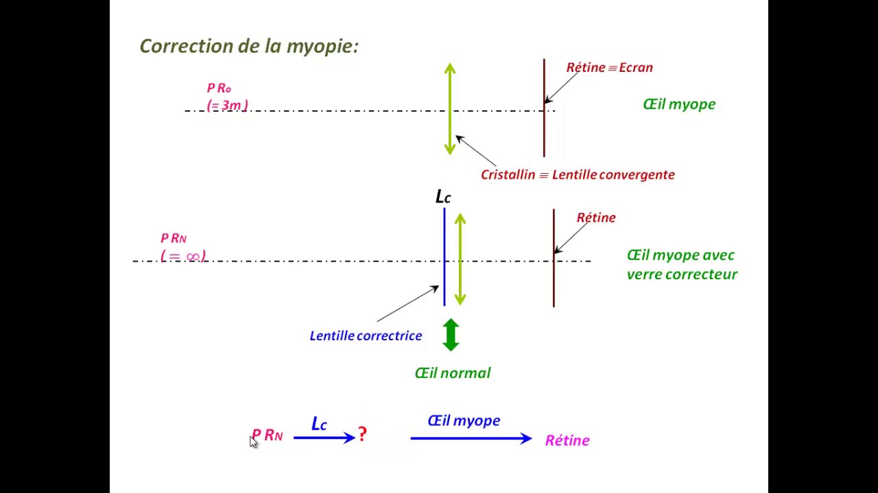 Comment corriger les défauts de l’œil : exercice corrigé en optique