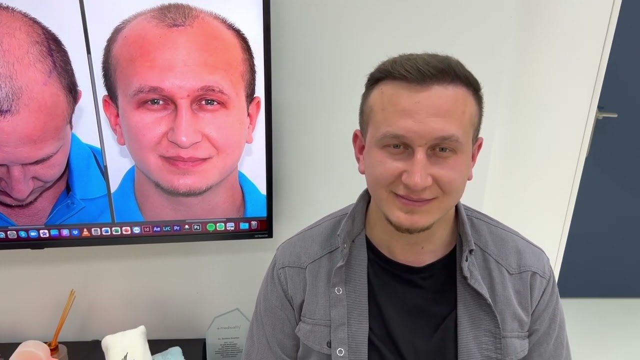 Saçekimi Sonrası Harika ERKEN Sonuç 5. AY - 6500 GREFT I Great EARLY Result After Hair Transplant