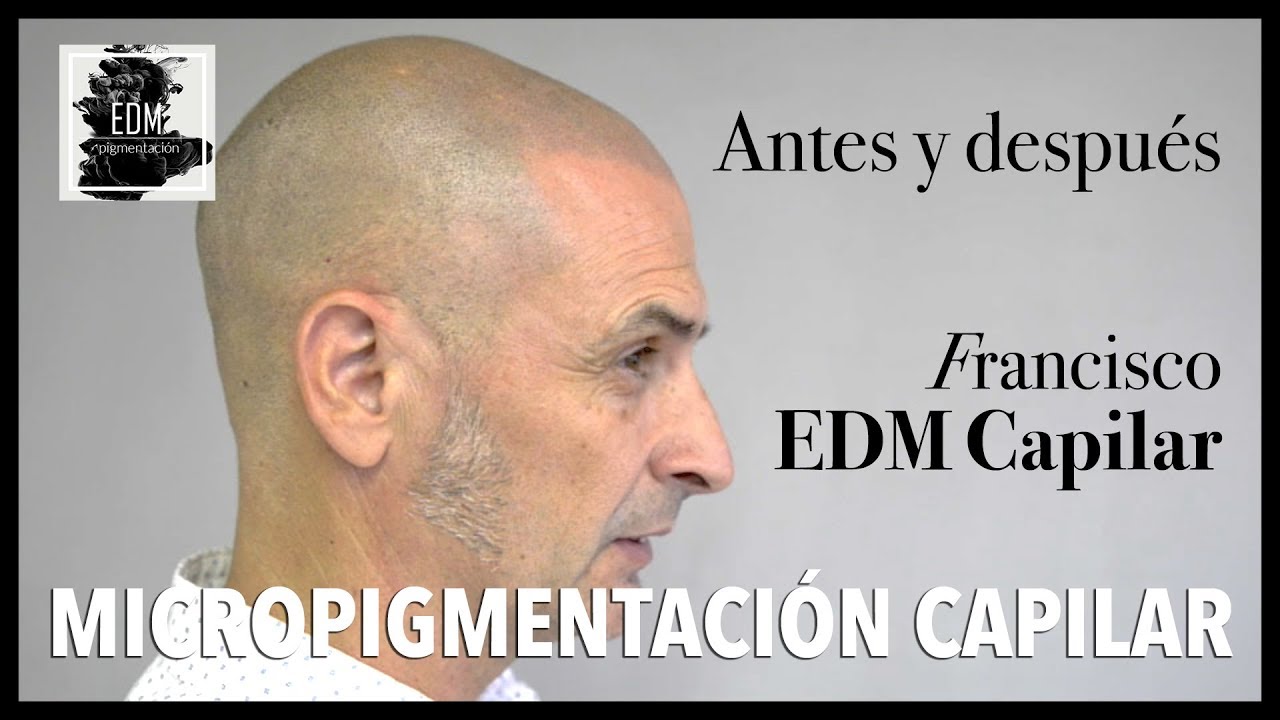Resultados de micropigmentación capilar. Antes y después en la alopecia de de Francisco