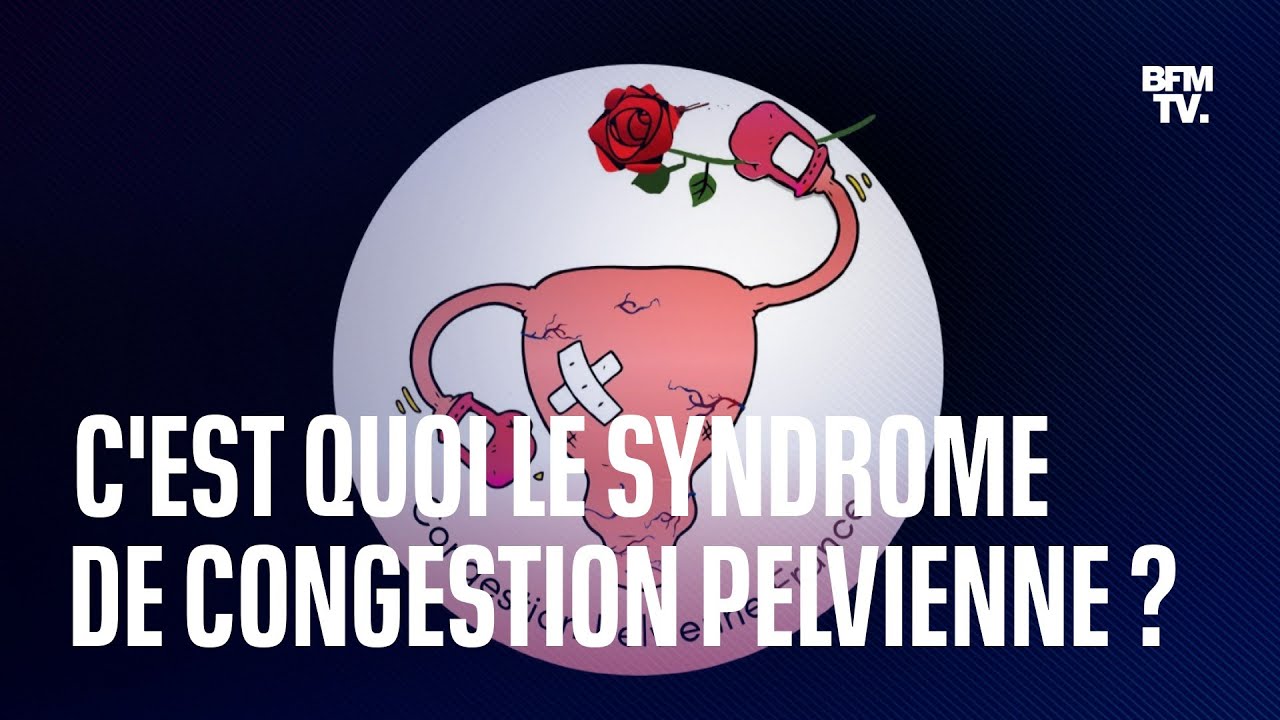 Qu&rsquo;est-ce que le syndrome de congestion pelvienne, souvent confondu avec l&rsquo;endom&eacute;triose ?