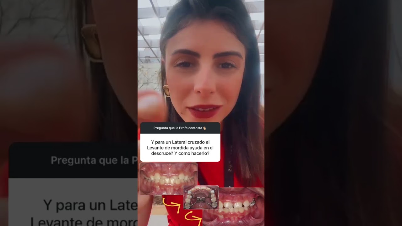 &iquest;Levante de mordida realmente ayuda a descruzar un lateral cruzado? Dra. Rayane Pinto CROSP | 110005