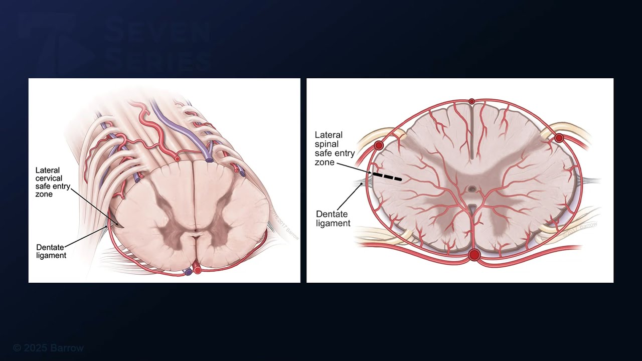 Microsurgical Resection of a Thoracic Spinal Cord Cavernous Malformation in a Patient with FCMS