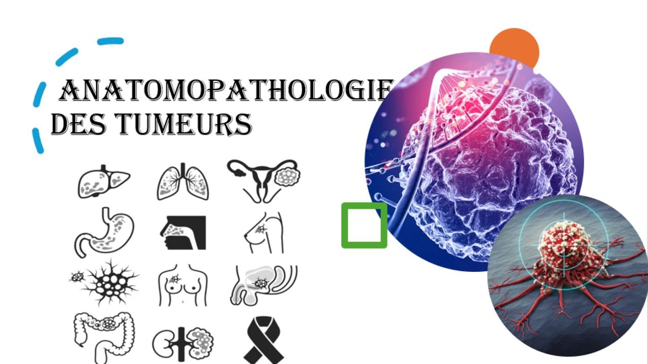 Comment classer une tumeur ? Bases de l&rsquo;anatomopathologie / Tumeurs b&eacute;nignes ou malignes ?