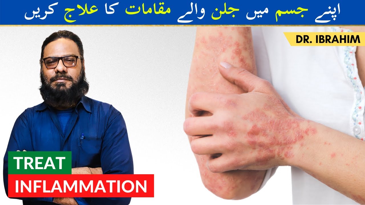 How To Treat Inflammation in Body | Sena, Hath, Paon, Maida Ki Jalan/Sozish Ka Ilaj in Urdu/Hindi
