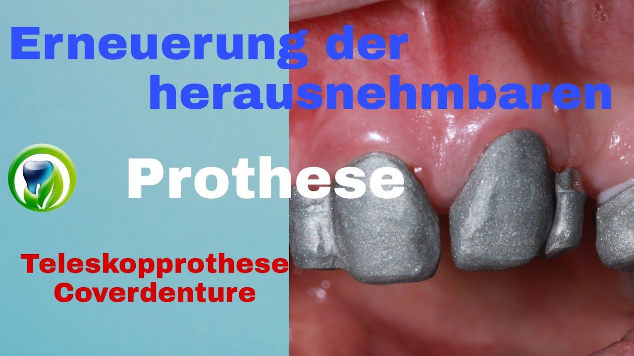 Erneuerung der herausnehmbaren Teilprothese - Teleskopprothese - Coverdenture