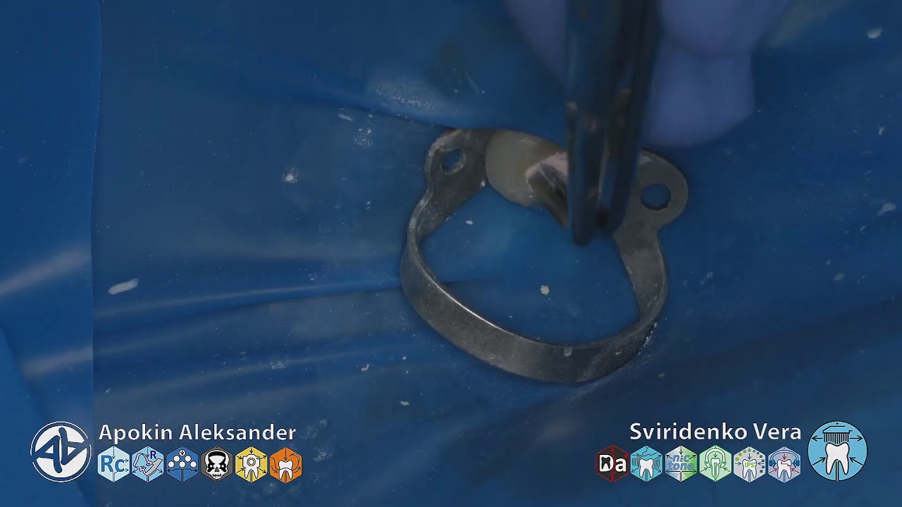 Endodontisc 14 root canals irrigation hypochlorite with DTE PT 5 (FHD multistream)