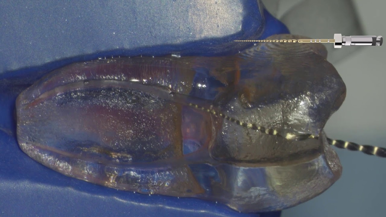 END Video TruNatomy Preserving the natural anatomy EN
