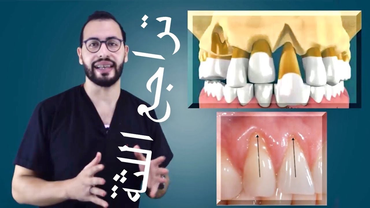 ⁉️ماذا يحدث لاسنانك بسبب التهابات وجيوب وتراجع اللثة و كيف تتخلص نهائيا منهم⚠️ بالطريقة الصحيحة؟!