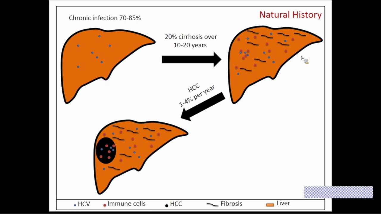 Updates in Hepatocellular Carcinoma