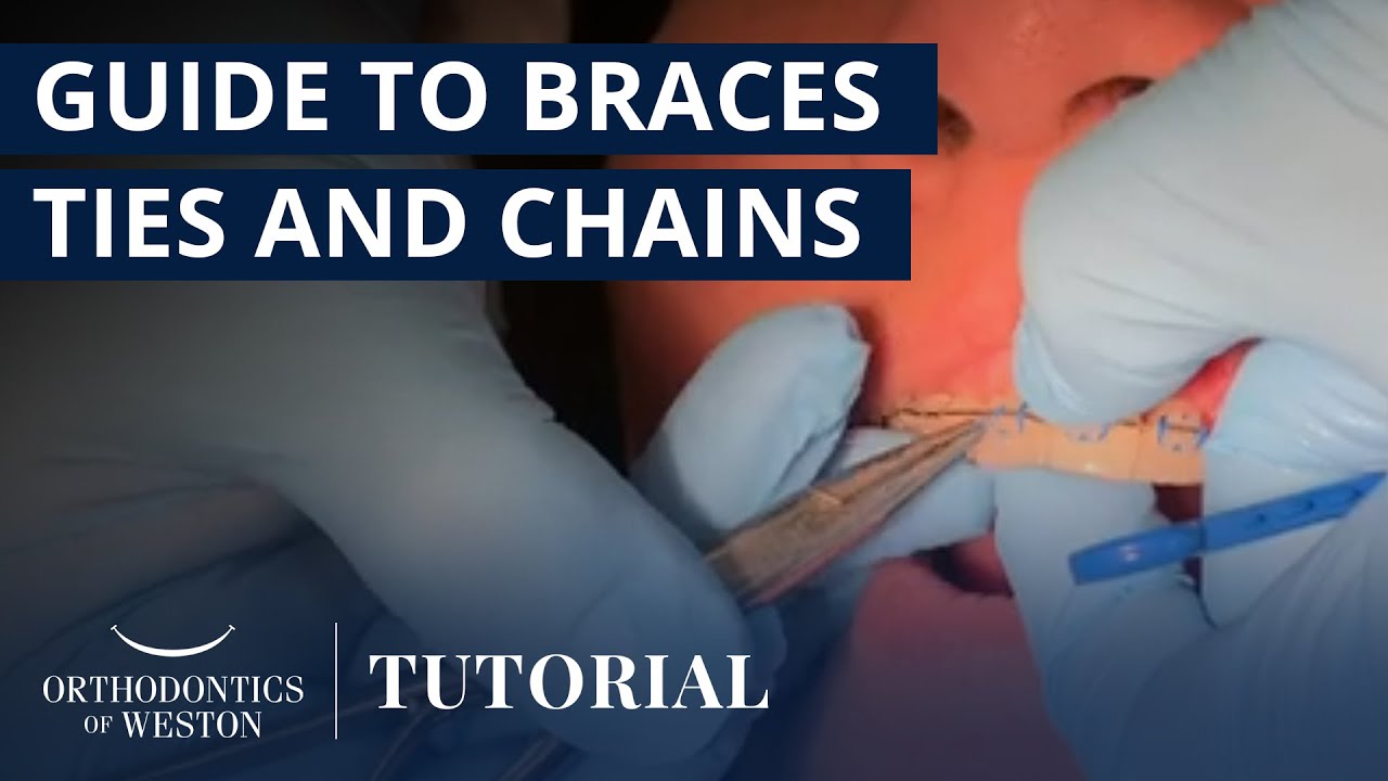 How to Use Elastic Ties, Power Chains, and Steel Ties | Orthodontics of Weston - Dr. Marissa Cooper