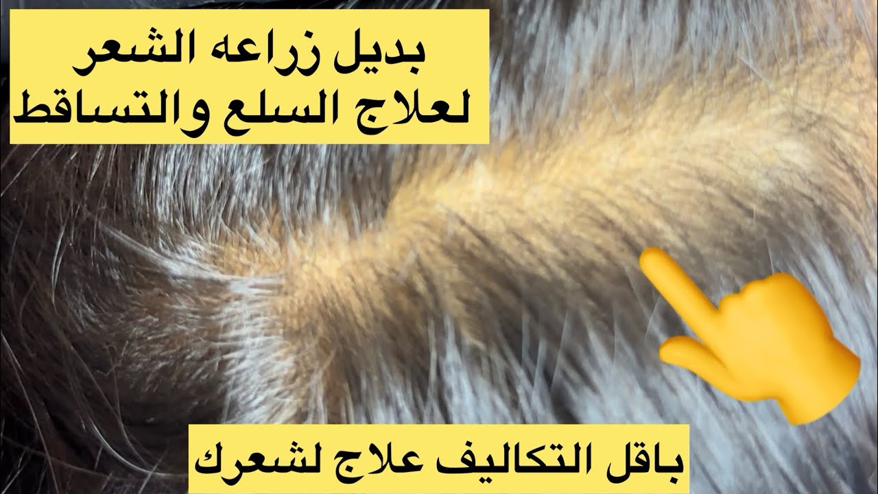 الحل الوحيد لعلاج فراغات الشعر والصلع وتساقط الشعر بديل الزراعه بقي سهل وبي اقل التكاليف