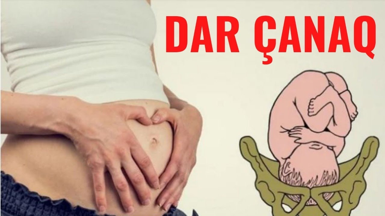 Dar Çanaq Və Doğuş- Nə Vaxt Təbii Doğuş Olmaz?