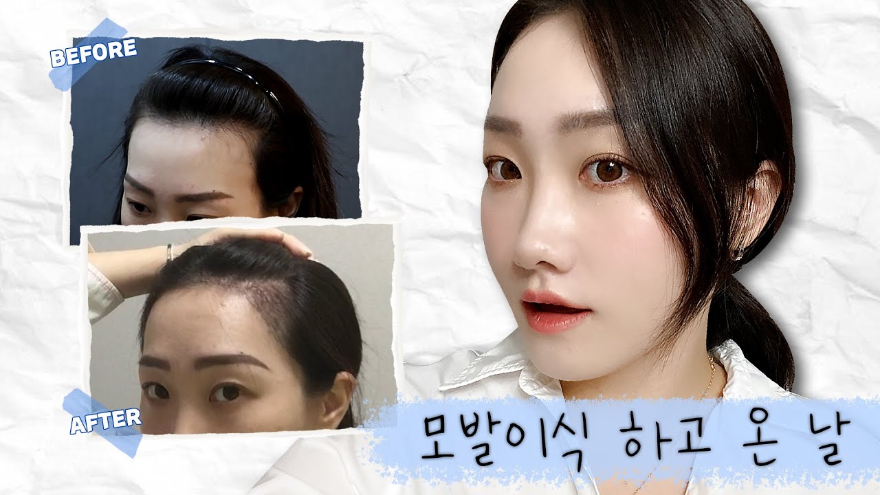20+n년 차 인생에 가장 큰 위기...빈 곳 다 덮고 왔습니다👀 M자 탈모를 발견한 순간 이미 게임 OVER!? 모발이식하고 한 달 뒤까지✔[쀼]
