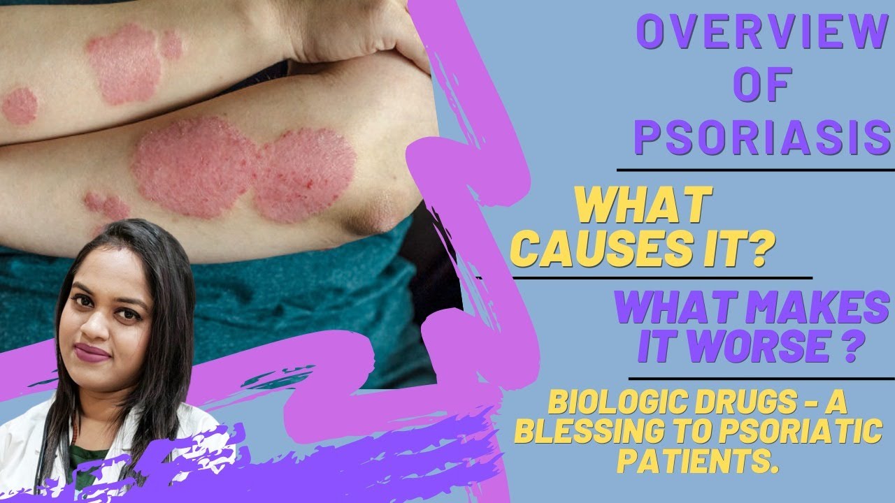 OVERVIEW OF PSORIASIS | Causes & Treatment | Biologic drugs - A Blessing to PSORIATIC patients