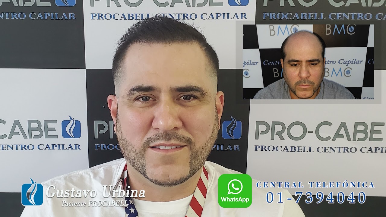 TRASPLANTE CAPILAR MÉTODO PROCABELL - TESTIMONIO GUSTAVO URBINA - PROCABELL CENTRO CAPILAR