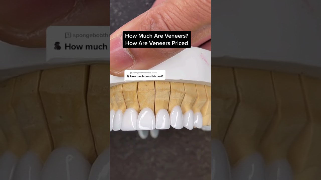 How much do veneers cost and how are they priced?