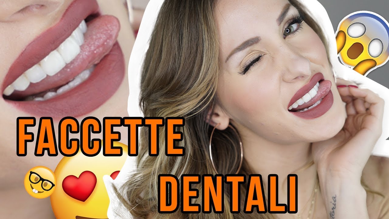 DENTI FINTI ?!?! FACCETTE DENTALI E RISULTATO NATURALE!