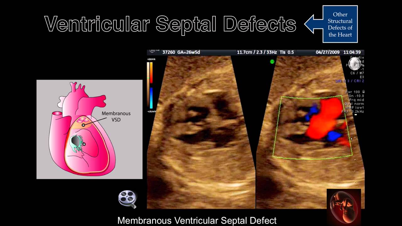 Fetal Echocardiography: Ventricular Septal Defects
